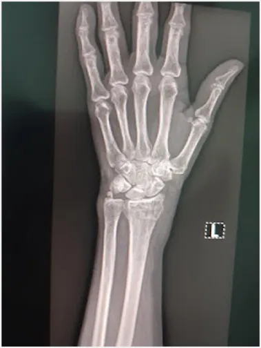 Osteoporosis prevention through healthy eating, exercise, and early detection as part of NCD prevention.
