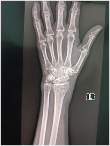 When Bones Become Fragile: A Story of Prevention